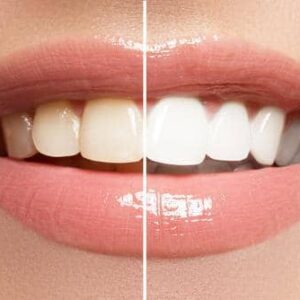 چگونه دندان ها را به طور طبیعی سفید کنیم؟